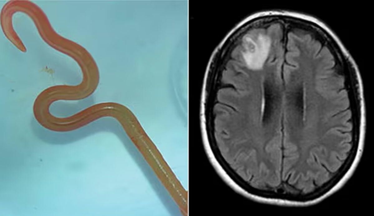 Unutkanlık ve depresyon şikayetiyle doktora gitti: Beyninde piton yılanlarında bulunan solucan çıktı