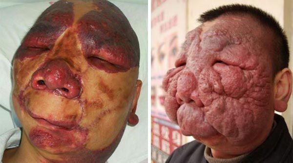 Yüzünü kaplayan tümörlerden kurtuldu