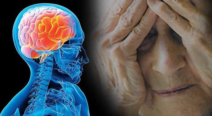 Alzheimer hastalığı tarihe karışıyor