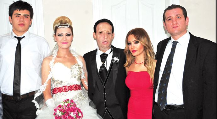 Türkiye&#039;de 5&#039;inci yüz nakli olan Recep Sert evlendi
