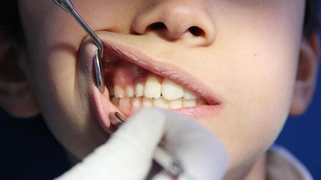 Diş çürümesini yavaşlatan bakteri bulundu