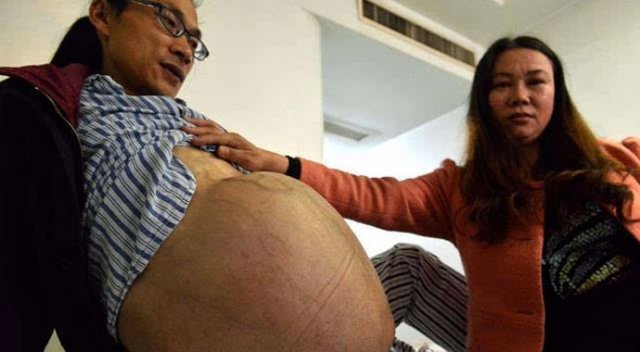 Çinli adamın karnından 31 kiloluk tümör çıktı