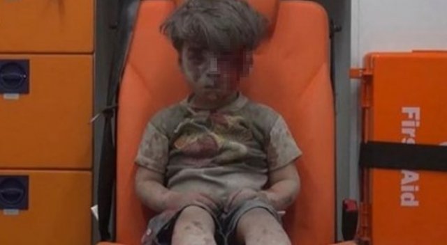Suriyeli Umran ağır yaralı