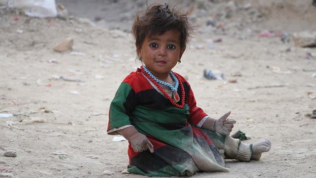 Afganistan&#039;da kalbi delik 11 bin çocuk tedavi olmayı bekliyor