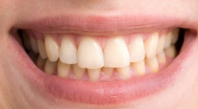 Diş sararması en çok neden meydana gelir?