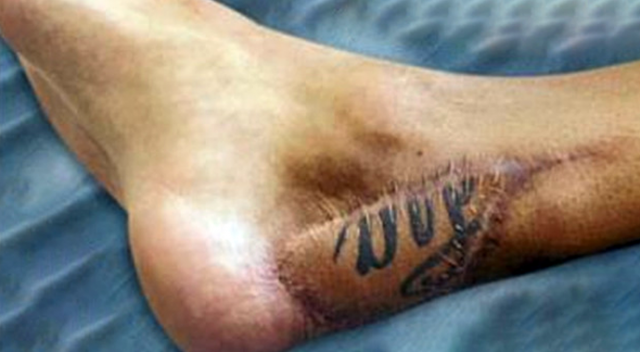 Santi Cazorla&#039;nın ayağının son hâli içler acısı
