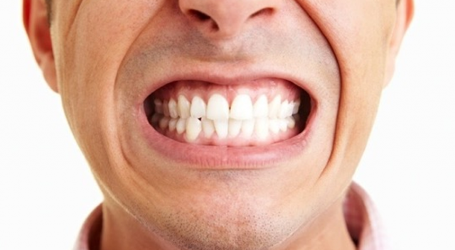 Diş sıkma ağız yapısını bozuyor