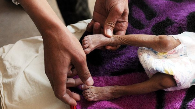 Yemen&#039;deki difteri salgınında ölü sayısı artıyor