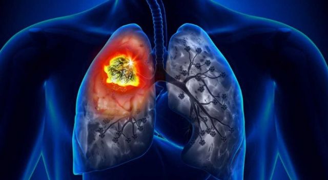 Sigara içenlerde Akciğer kanseri görülme riski 36 kat artıyor