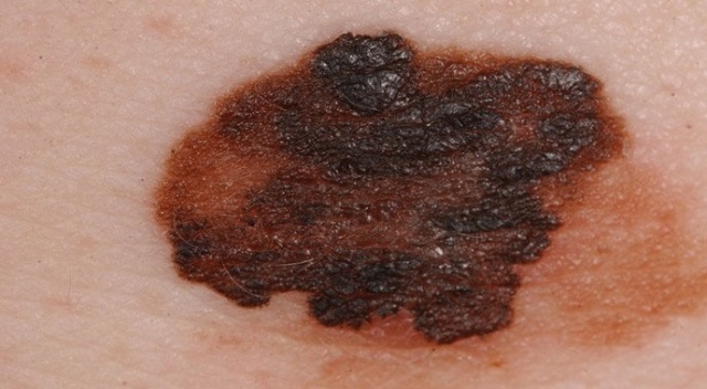 “Malign melanom, ölüm oranlarını yüzde 44 arttırıyor”
