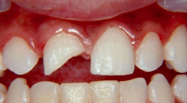 Dişlerdeki kırık problemine dikkat! Kırık Dişler Nasıl Tedavi Edilebilir?