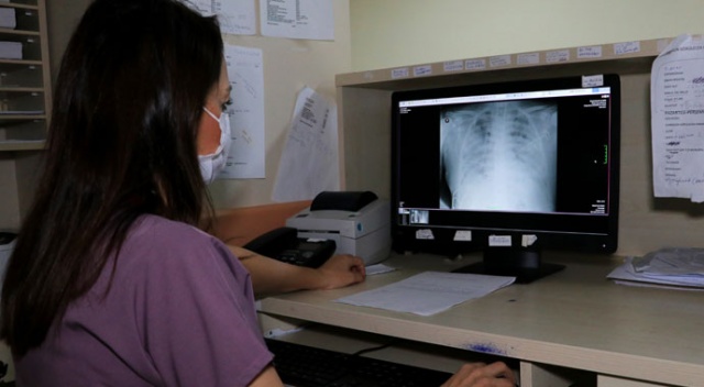 Covid-19 hastalarının akciğer röntgenleri ürküttü
