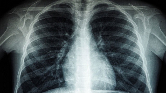 Covid-19 tedavisinde önemli keşif: Koronanın akciğer zararını sınırlandırıyor
