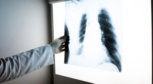 Uzmanı uyardı: Covid-19 salgını akciğerlerde kalıcı hasar bırakabilir