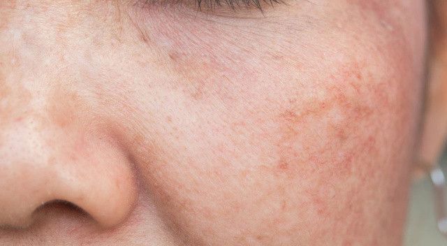 UV ışınlarına dikkat: Güneş hasarı cildi yaşlandırıyor