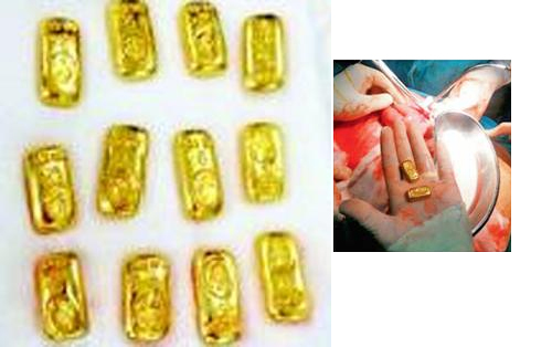Midesinden 400 gram altın çıkan işadamı sorgulanıyor