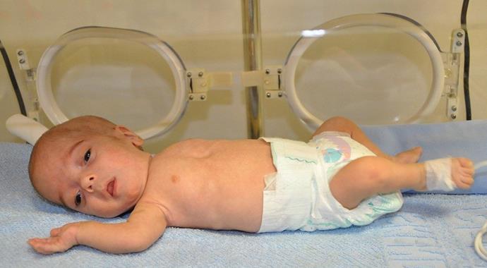 780 gram doğan parmak bebek sağlığına kavuştu