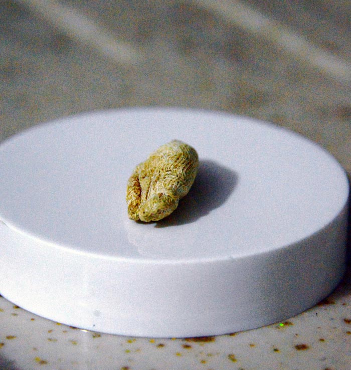 'Ameliyatta sargı bezi unutuldu' iddiası!