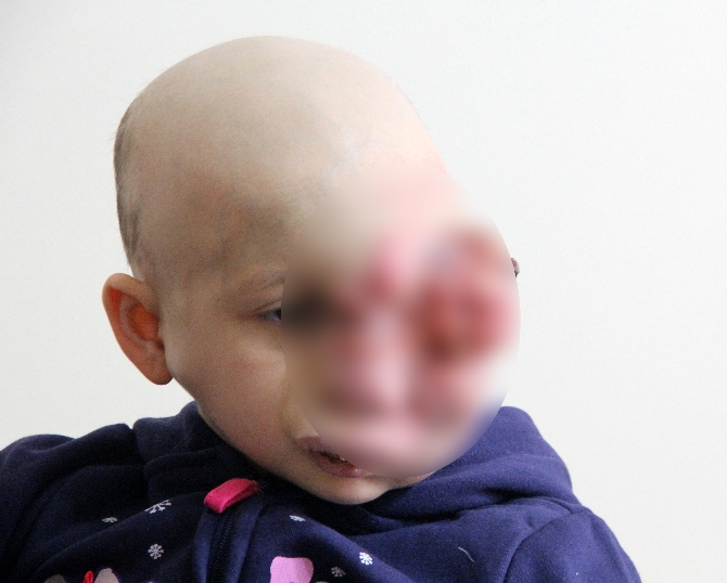 Küçük bir sivilce minik kızın hayatını kararttı