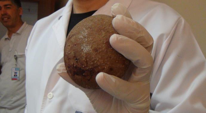 Bel ağrısı diye gitti, mesanesinden 10 santimetrelik taş çıktı