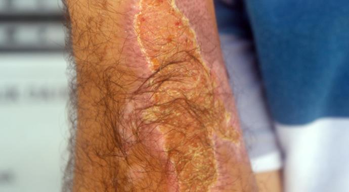 Sigara böreğini kızartırken hastanelik oldu