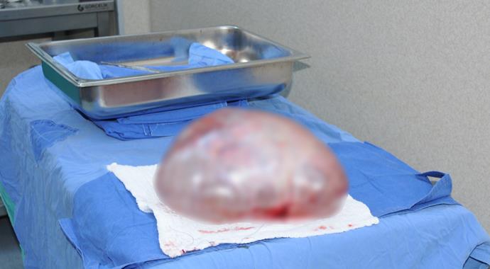 Karın ağrısı diye gitti, 11 kiloluk tümör çıktı