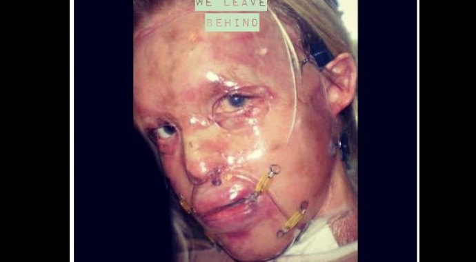 Kezzap saldırısına uğrayan Katie Piper'in son hali herkesi şaşırttı