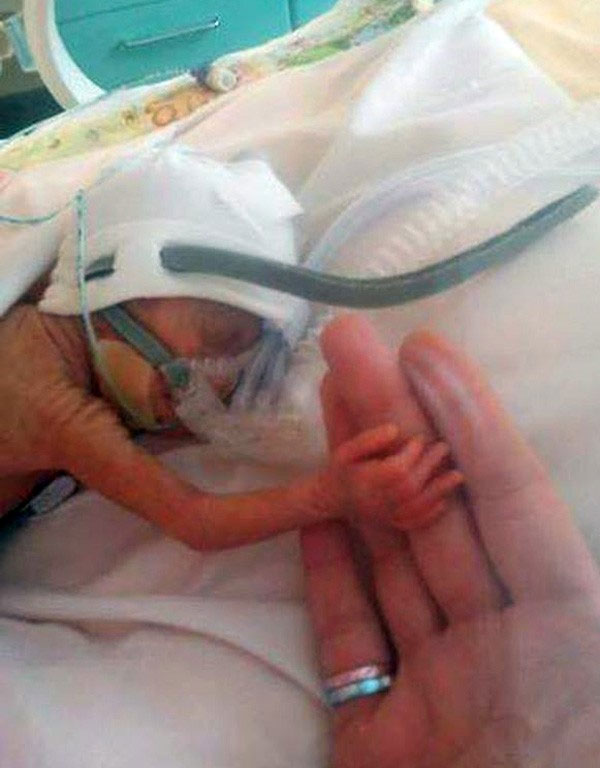 24 haftalık bebek buzdolabı poşetiyle hayata tutundu