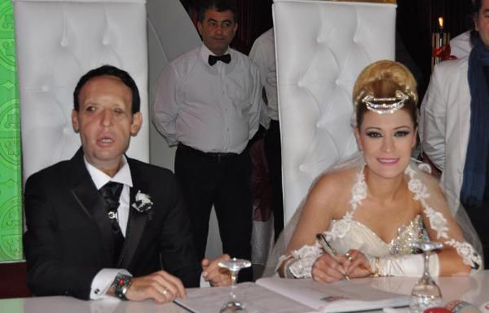 Türkiye'de 5'inci yüz nakli olan Recep Sert evlendi