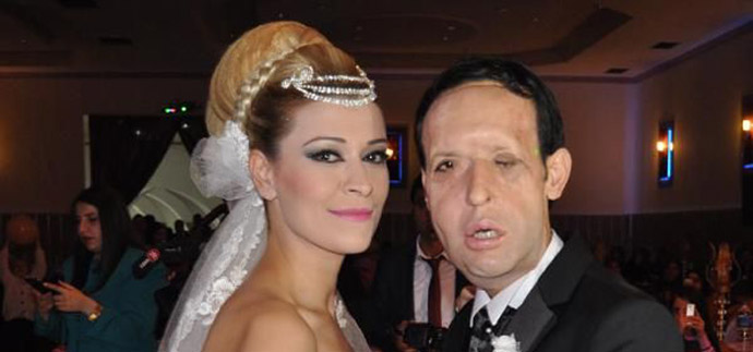 Türkiye'de 5'inci yüz nakli olan Recep Sert evlendi