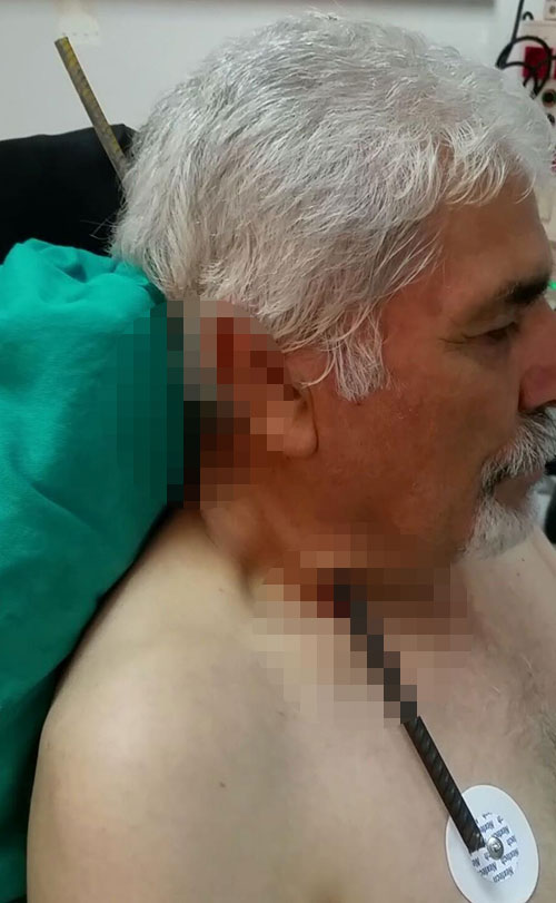 İnşaatta dolanırken boynuna 6 metrelik demir saplandı