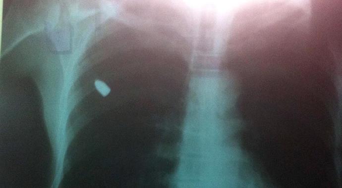 'Göğsüme taş geldi' dedi, kurşun çıkartıldı