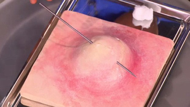 Mehmet Öz'den sivilce önerisi!