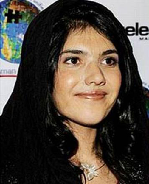 Afgan kadın Ayşe yeni burnuna kavuştu, işte o görüntüsü...