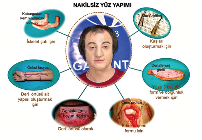 Kendi derisinden yeni yüz yapıldı