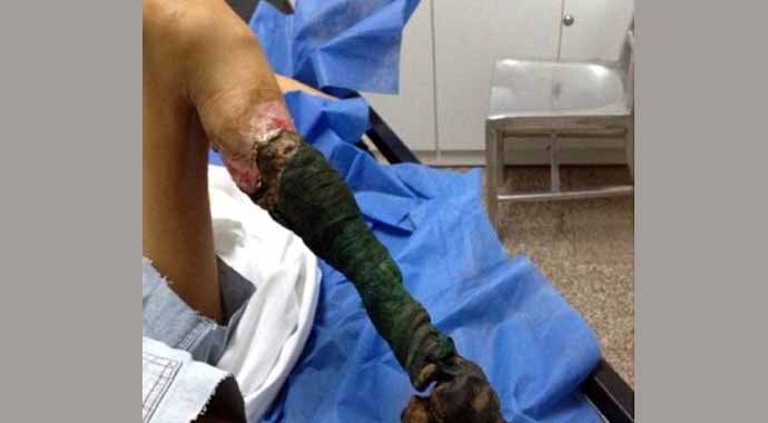 Yılan ısırığı bu hale getirdi! Bacağı çürüdü