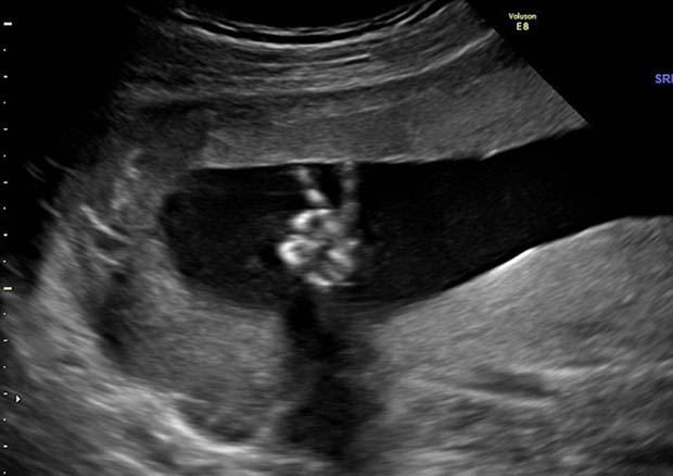 Anne karnında ilk zafer