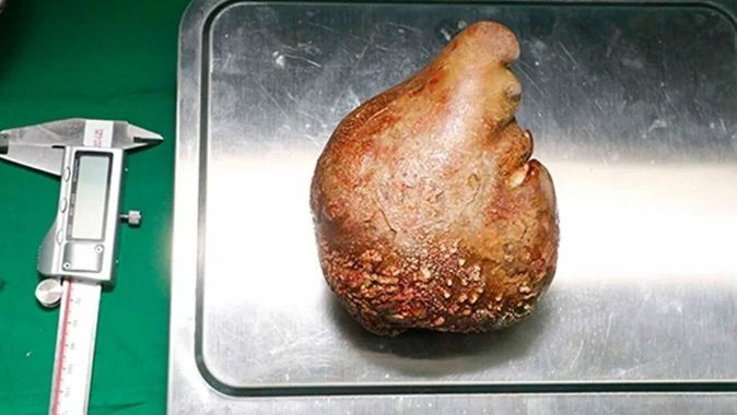 Dünya rekoru kırıldı: Hastadan 801 gram ağırlığında böbrek taşı çıkarıldı