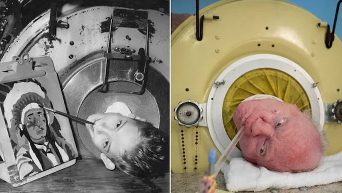 Altı yaşında çocuk felci geçirdi... 72 yıl boyunca bu tankın içinde yaşadı