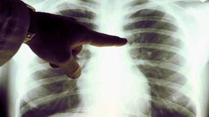 Akciğer kanserinde korkutan değişim