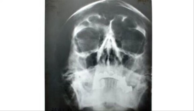Hitler&#039;in kafatası röntgeni açık artırmada!