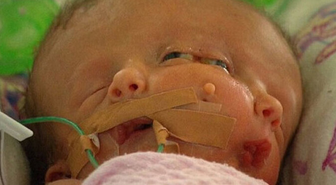 Tıp tarihine geçen doğum: &#039;İki yüzlü ikiz bebek&#039;