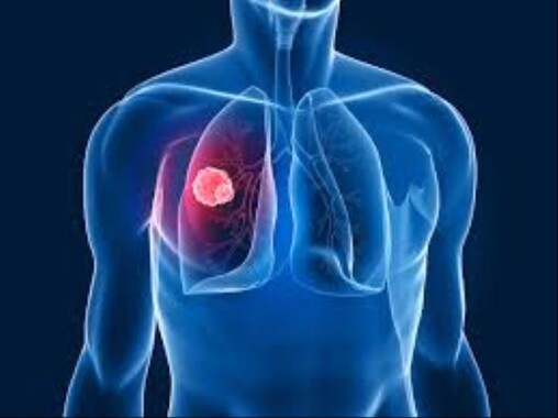 Akciğer kanserinin tedavisi bulundu