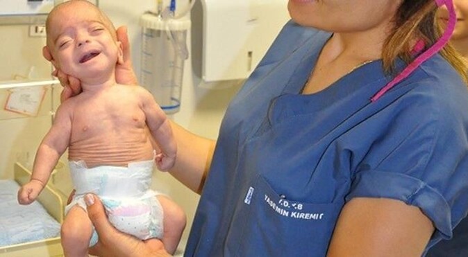780 gram doğan parmak bebek sağlığına kavuştu