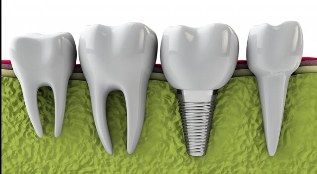 Ucuz diş implantlarına dikkat!