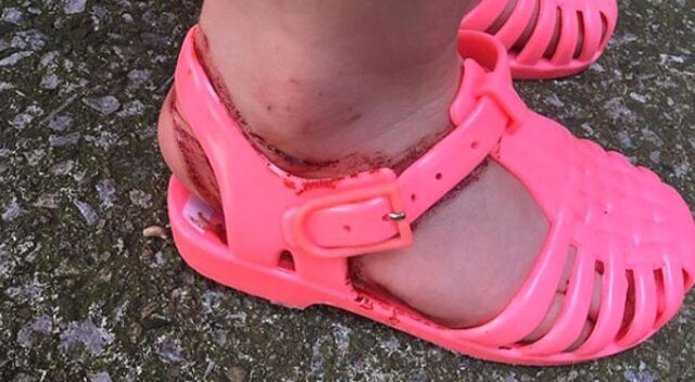 Sandalet, küçük kızın ayağını yarım saatte kanlar içinde bıraktı