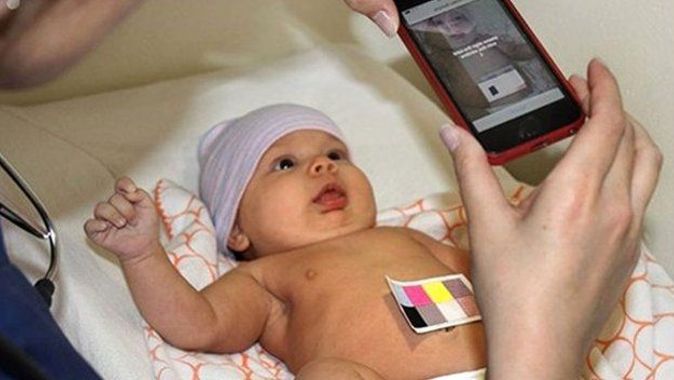 Yeni doğan bebeklere acısız sarılık testi