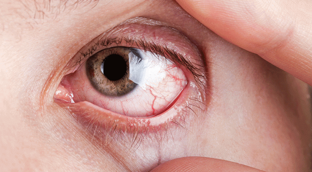 Gözdeki sinsi hastalık: Glokom