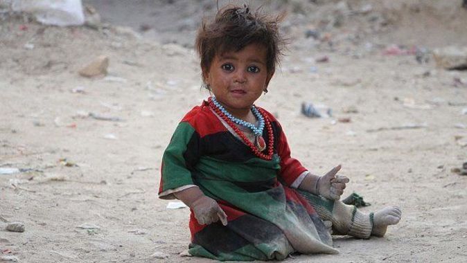 Afganistan&#039;da kalbi delik 11 bin çocuk tedavi olmayı bekliyor