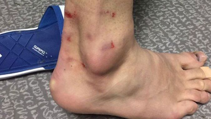 Volkan Şen, ayağına aldığı darbeden sonra ayağının fotoğrafını paylaştı